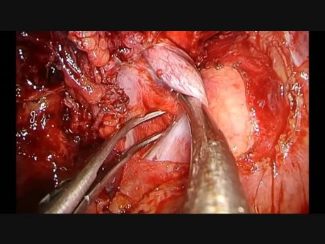 Uniportal Vats Intrapericardial Bilobectomy With Superior Cava Vein Partial Resection