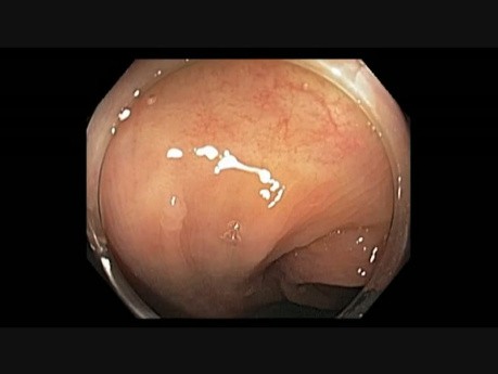 Subtle Polyp - Cap Helps