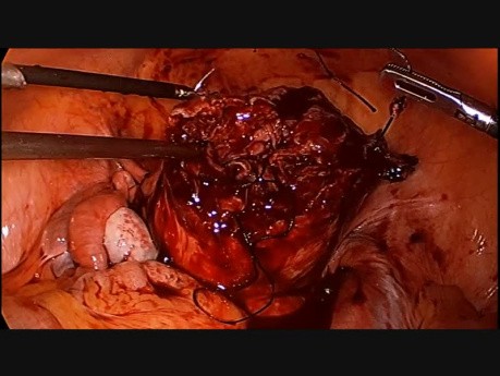 Laparoscopic Myomectomy for Large Intramural Myoma