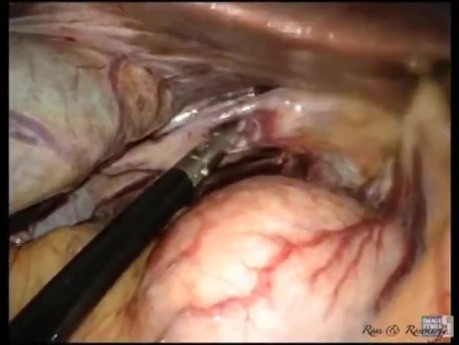 The Evolution of LESS Cholecystectomy without General Anesthesia