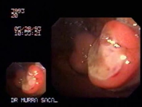 Multiple Gastric Gastrointestinal Stromal Tumor (GIST)