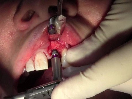 Osteotomy Prep & Implant Insertion - Implant Placement #9