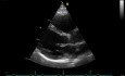 Real-Time Three Dimensional Echocardiography - Parasternal Long Axis View on Mitral Valve, Video nr 2