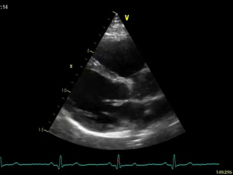 Real-Time Three Dimensional Echocardiography - Parasternal Long Axis View on Mitral Valve, Video nr 2