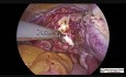 Laparoscopic Hysterectomy and Cholecystectomy together with Removal of Gallbladder Though Vagina