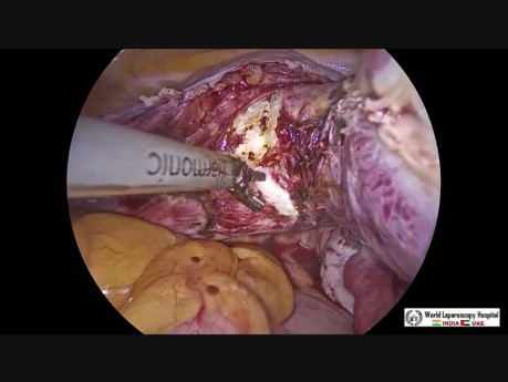 Laparoscopic Hysterectomy and Cholecystectomy together with Removal of Gallbladder Though Vagina