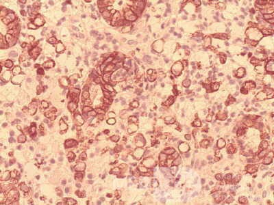 Ascending Colon Cancer (9 of 9)