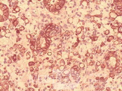 Ascending Colon Cancer (9 of 9)