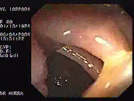 Sessile Villous Adenoma (1 of 3)