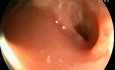 Colovesical Fistula