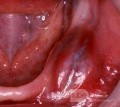Odontogenic Keratocyst
