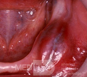 Odontogenic Keratocyst