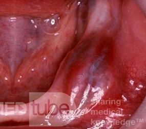 Odontogenic Keratocyst