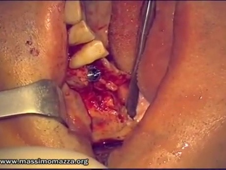Immediate Implantation 14-18 (2/2)