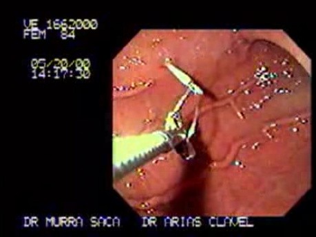 Percutaneous Endoscopic Gastrostomy (2 of 3)