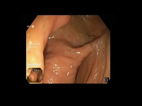 Inverted Appendix