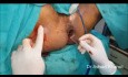 Longest Fistula Treatment