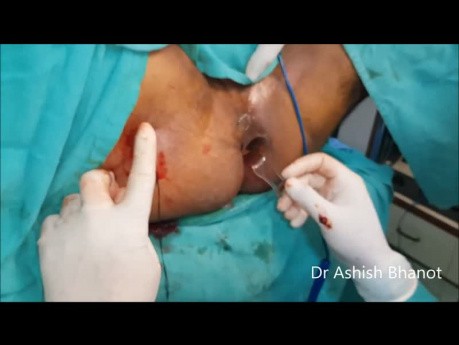 Longest Fistula Treatment