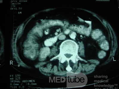 Pseudomembranous Colitis (9 of 11)