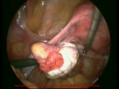 Ectopic Pregnancy