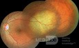 Ocular Metastasis from Lung Cancer