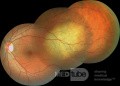 Ocular Metastasis from Lung Cancer