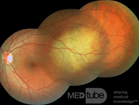 Ocular Metastasis from Lung Cancer
