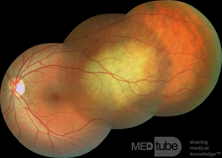 Ocular Metastasis from Lung Cancer