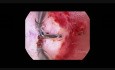 Subseptate uterus