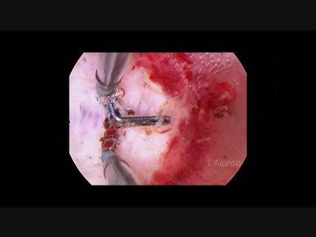 Subseptate uterus