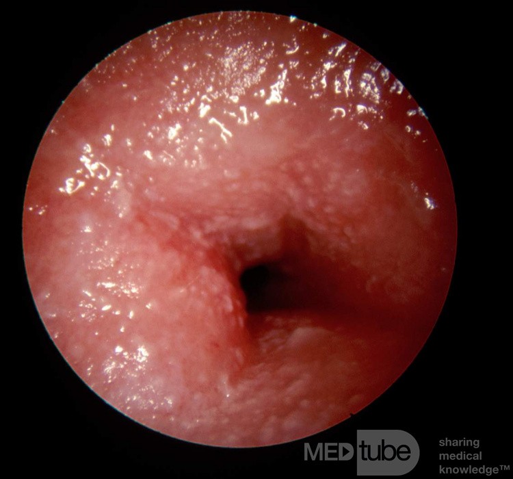 Acute Allergic Contact Dermatitis of the External Canal