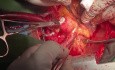 Patient with Mitral Valve BE and as a Source of Brain Embolism and Resultant CVA