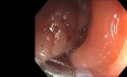 Endoscopic Giant Polyp Polypectomy - Descending Colon