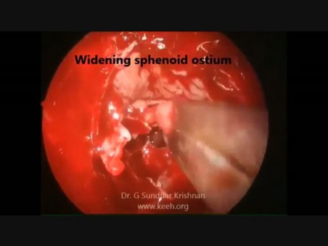 Bilateral Allergic Fungal Rhinosinusitis