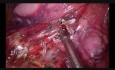 Uniportal Vats Left Anatomic Anterobasal Segmentectomy S8 (Live Surgery to Milan During the EACTS)