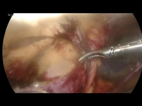 Left Inguinal Hernia - Laparoscopic Trans-Abdominal Pre-Peritoneal Plate Repair