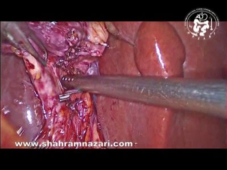Roeders Knot for Cystic Duct Closure