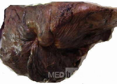 Lung Adenocarcinoma (4 of 5)