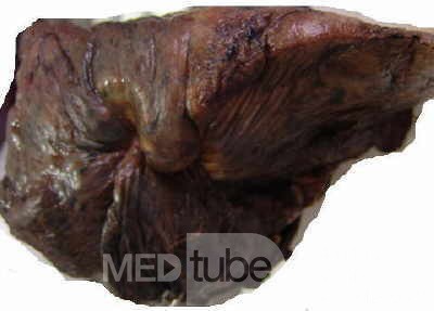Lung Adenocarcinoma (4 of 5)