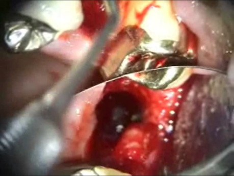 Dental Implant Microsurgery: Removal and Replacement