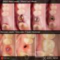 Dental Implant in Posterior Region