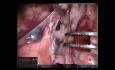 Sixth Segmentectomy, Robotic Lung Surgery