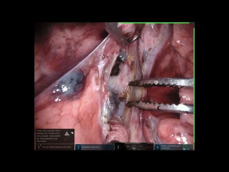 Sixth Segmentectomy, Robotic Lung Surgery