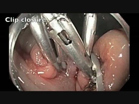 Colonoscopy - Ascending Colon - Flat Lesion - Step IV - Clip closure