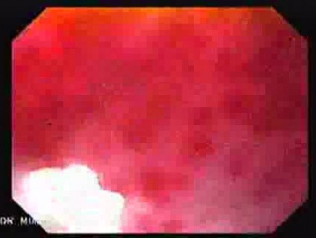 Endoscopic Variceal Ligation - Closer Look at the Varix (Magnifying View), Part 2