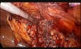 Laparoscopic Repair of Incisional Hernia by Two Ports