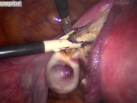 Laparoscopic Removal of The Uterus