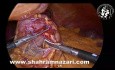 Concomitant Cholecystectomy During Laparoscopic Sleeve Gastrectomy