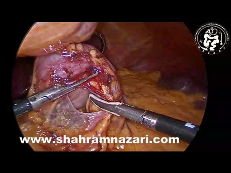 Concomitant Cholecystectomy During Laparoscopic Sleeve Gastrectomy