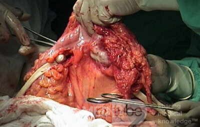 Metastasis of Renal Carcinoma to the ascending colon (7 of 11)
